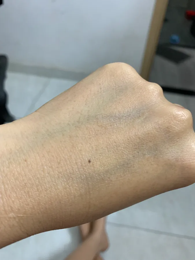 Da tay trước, bị nám
